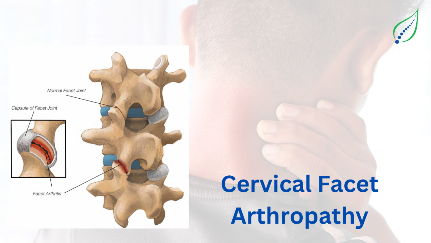 Cervical Facet Arthropathy
